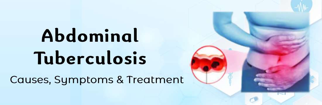 Abdominal Tuberculosis Symptoms and Causes:  A Comprehensive Overview